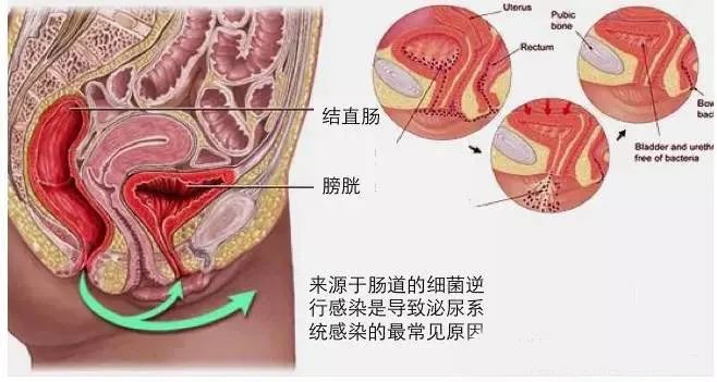关于泌尿系感染的那些事儿,尿路感染的健康科普