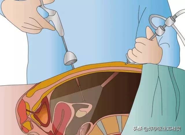 输卵管双侧粘连怀孕了还有希望吗,输卵管双侧粘连很多年意外怀孕