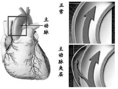高血压发生主动脉夹层概率,高血压犯的毛病主动脉夹层