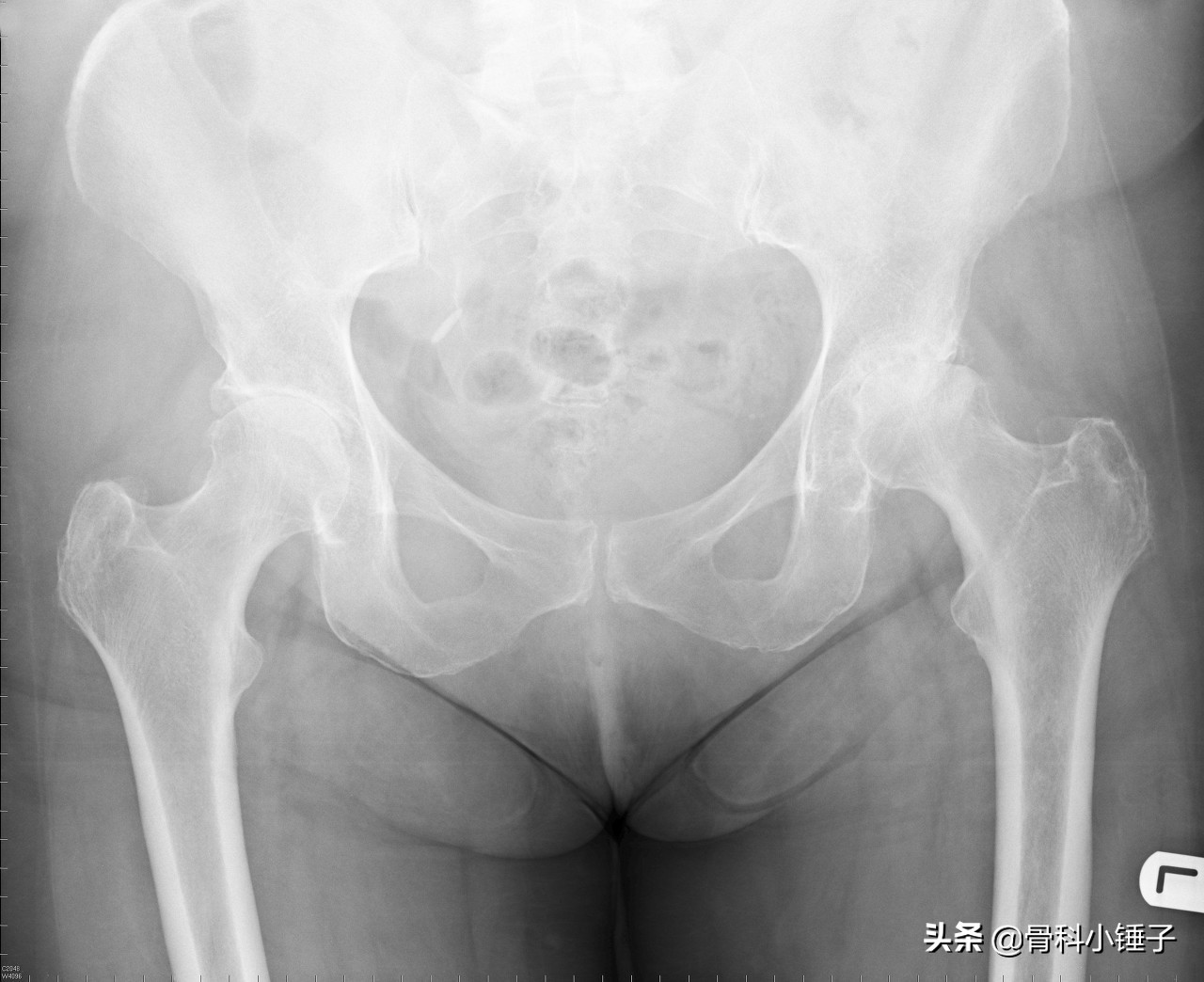 聊聊骨科的那些事儿,聊聊膝关节那些事