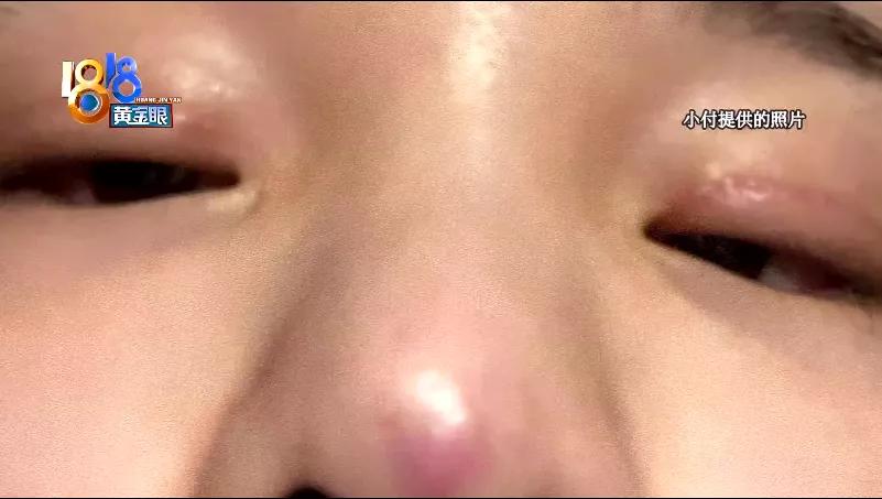 鼻部做了手术如何消除疤,鼻部修复恢复要多久