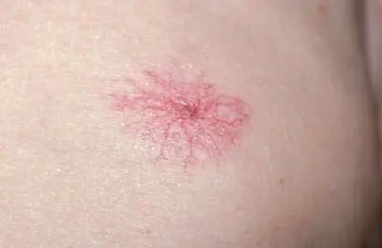 晚期肝癌和中晚期肝癌有什么区别,85岁肝癌晚期怎么治