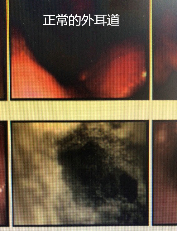 耳朵鼓膜穿孔图片,耳朵鼓膜穿孔什么感觉