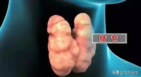 甲状腺疾病是碘不够还是摄入过量,甲状腺疾病的高发与加碘盐有关吗