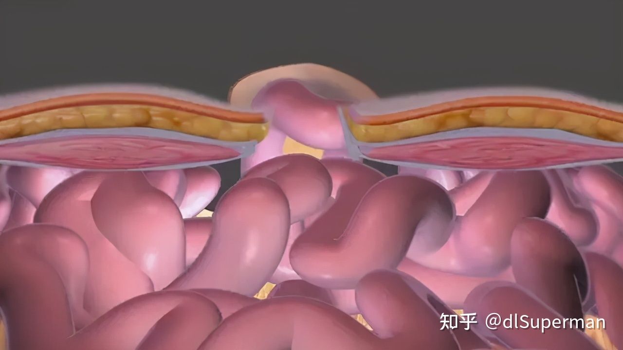 腹股沟疝术后要注意什么,孩子有腹股沟疝应该注意什么