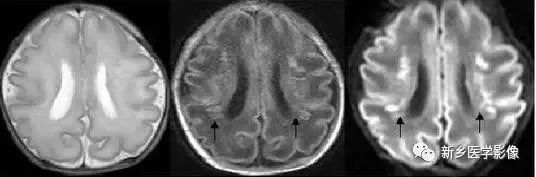 脑室影像学表现,脑室占位影像