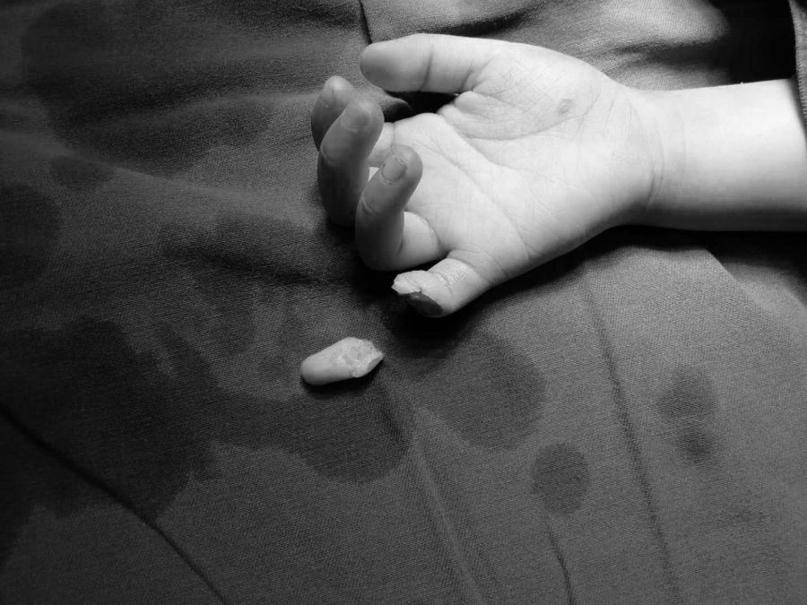 断指再植接动脉显微镜视频,穿针引线手术