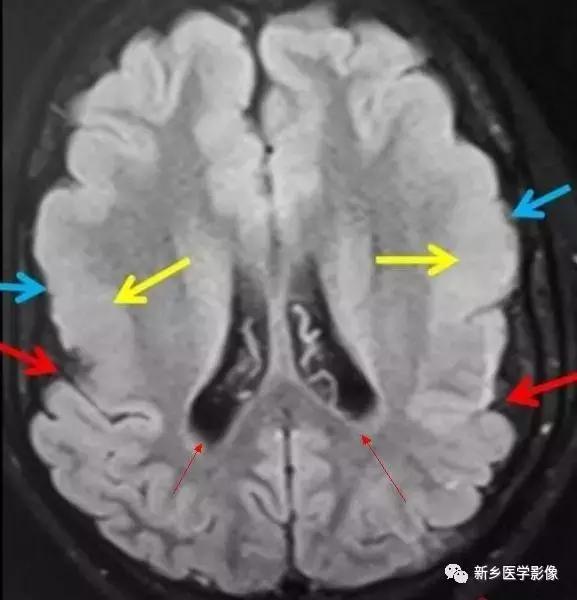 脑室为什么会扩张,脑室为什么会变小