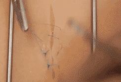 十种外科基本缝合方式详解,手术切口缝合有哪几种