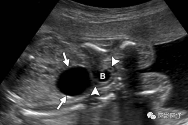 胎儿卵巢囊肿5.6厘米会消失吗,卵巢巨大囊肿与妊娠鉴别