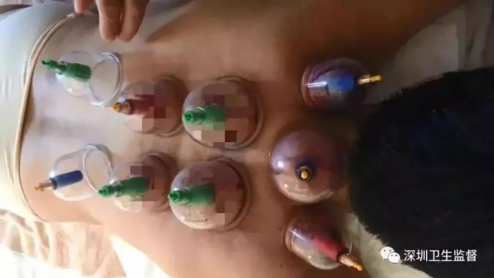 男子拔火罐收费2000多,男子拔火罐买单花了2000多