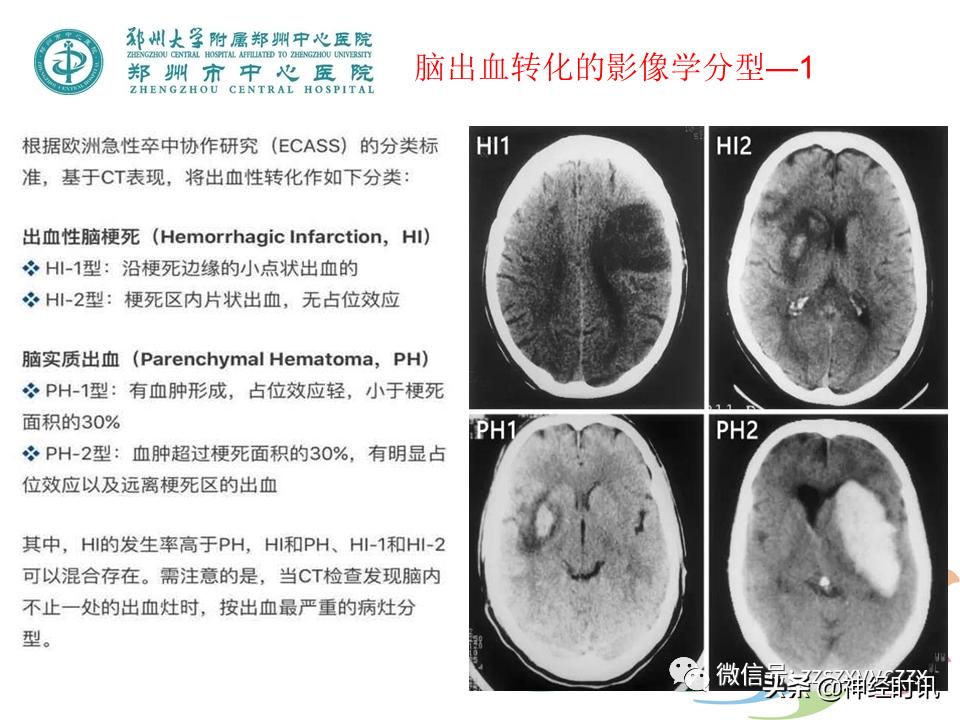 静脉溶栓怎么引起的,静脉相关并发症的预防及处理