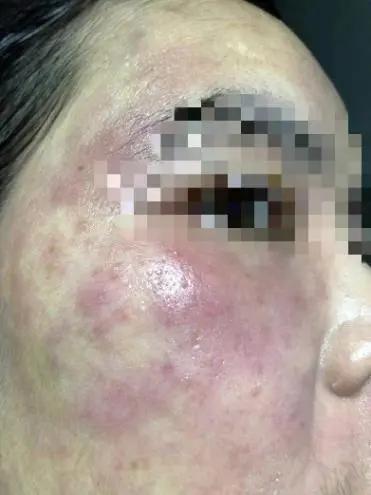 美容不成反毁容的案例,美容不做了皮肤会越来越差