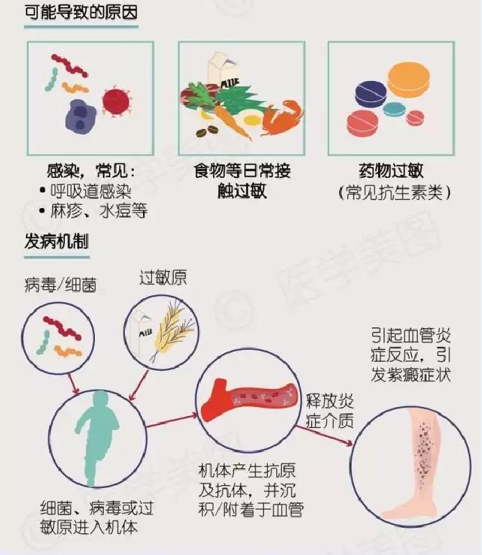 中西医结合治过敏性紫癜最好专家,中西医结合儿科过敏性紫癜