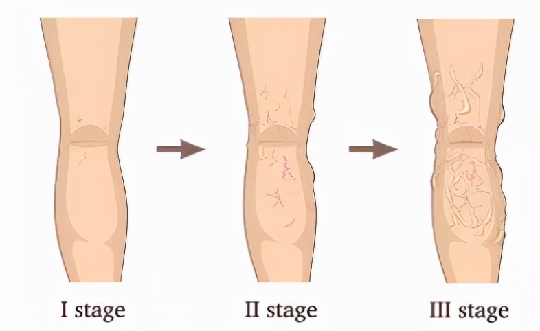 简单一招，教你判断自己是否患了静脉曲张