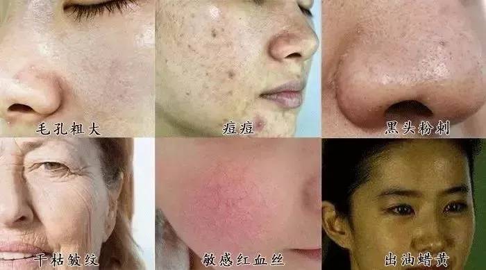 鼻子起痘都能挤出很多白色油脂,鼻子白色的痘痘挤出来有痘坑吗