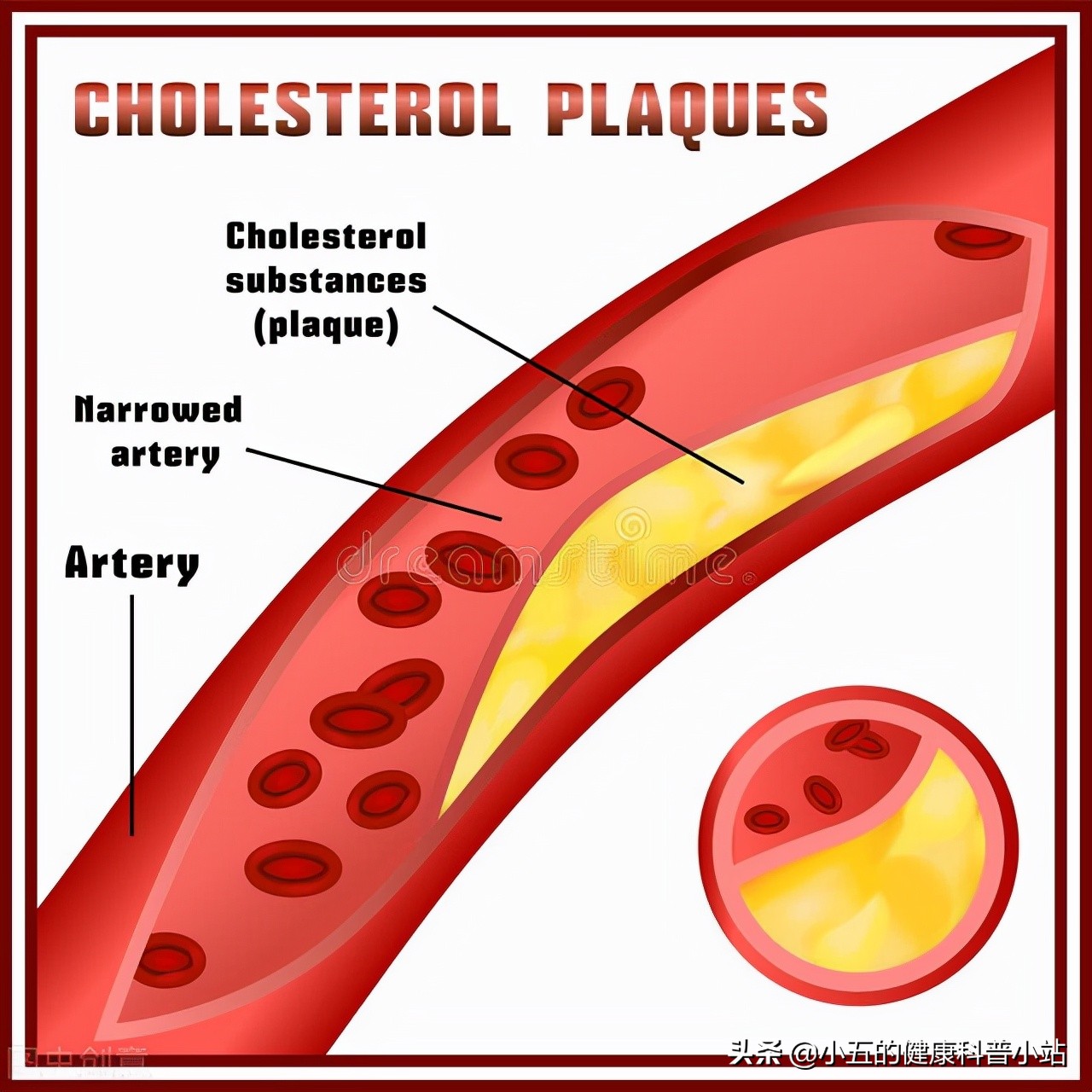 不稳定型心绞痛治疗中成药,治疗稳定型心绞痛中成药
