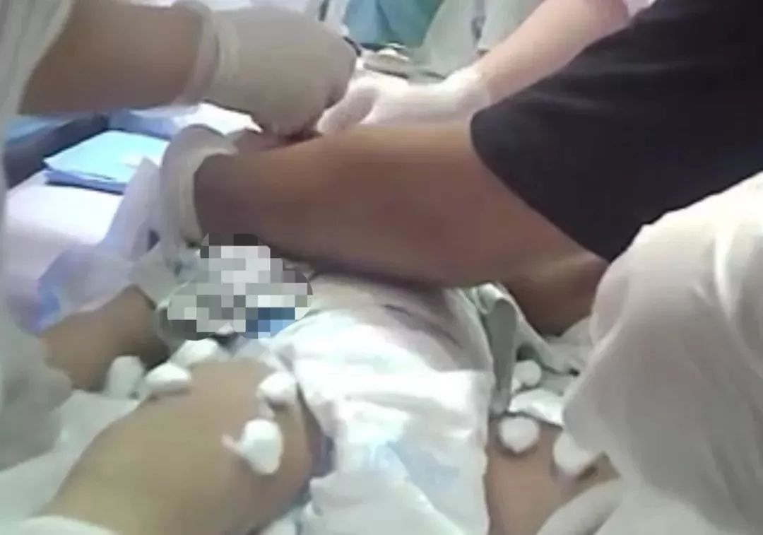 脑瘫封针疗法视频,封针疗法治疗脑瘫骗局