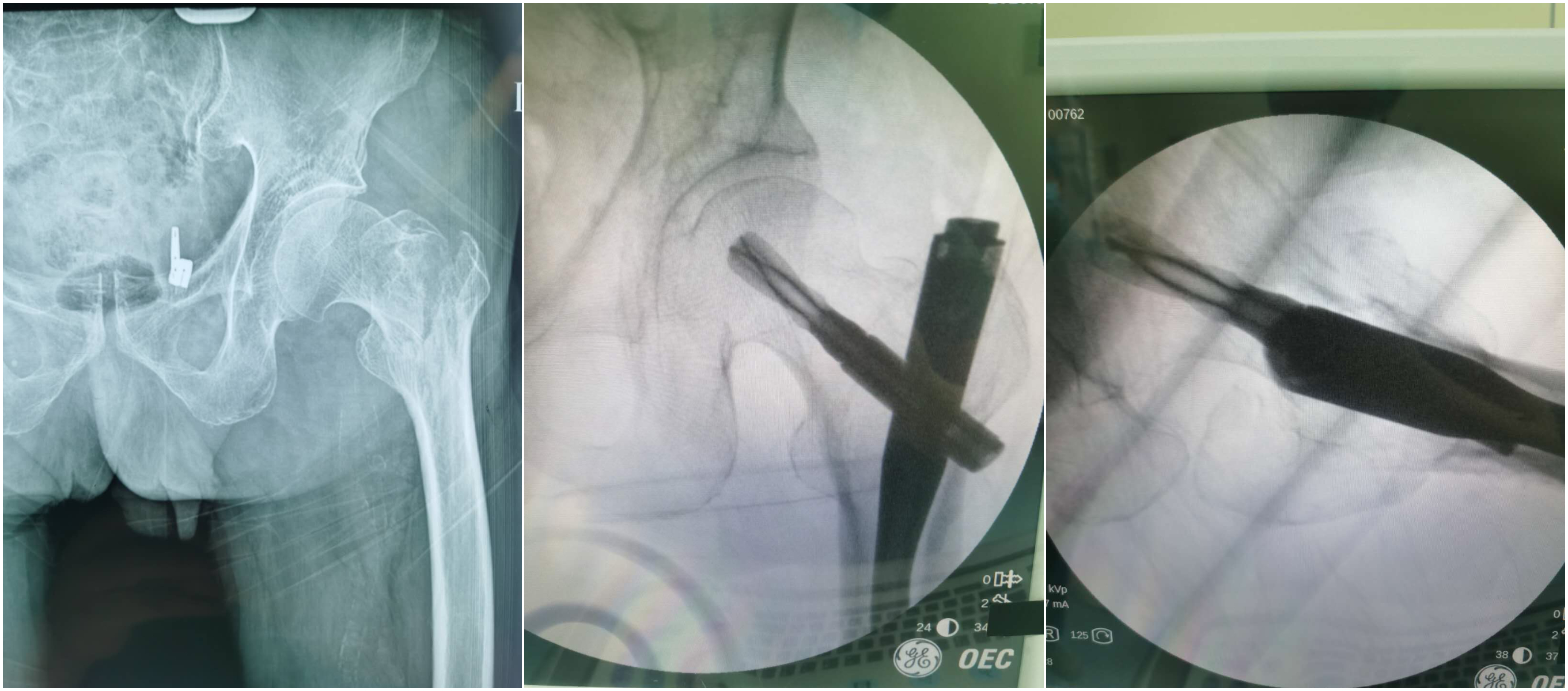人生最后一次骨折如何挽救,为什么叫人生最后一次骨折