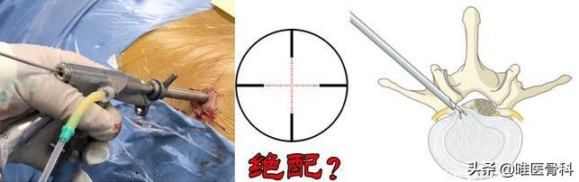 腰椎间盘突出医生建议手术怎么办,腰椎间盘突出打钉子和做镜子