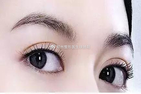 哪些人不适合做脸部吸脂,全切双眼皮吸脂和不吸脂的区别