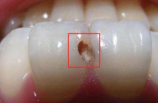 牙齿掉碎块的原因,牙齿掉渣是怎么回事