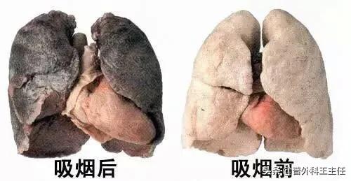 戒烟后咳嗽吐白痰是怎么回事,我戒烟2个月为什么咳嗽很厉害