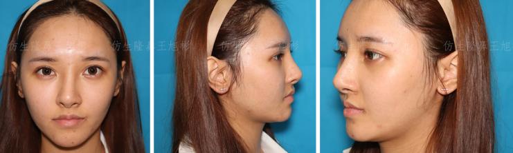 线雕隆鼻后鼻综合修复术,隆鼻失败修复手术真实案例