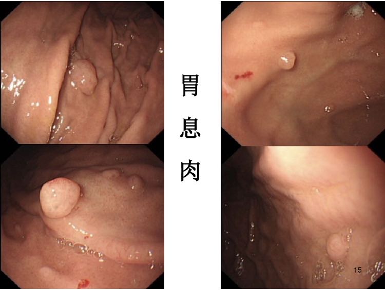 胃肠息肉会癌变么,长蒂息肉和无蒂息肉哪种容易癌变