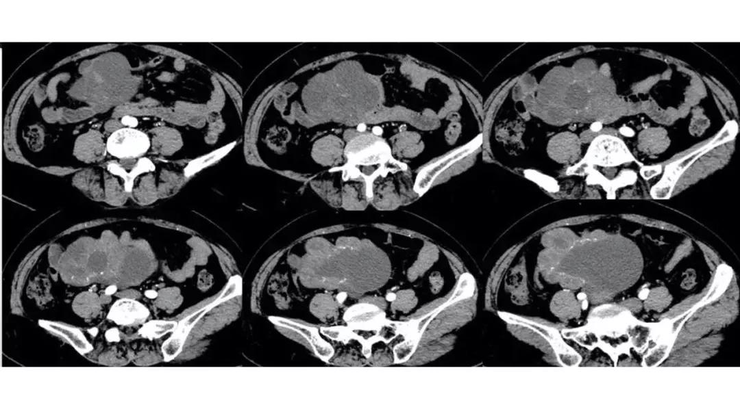 卵巢原发肿瘤的分析思路