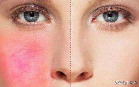 秋冬季节皮肤干燥发痒怎么办,秋冬皮肤干裂涂什么