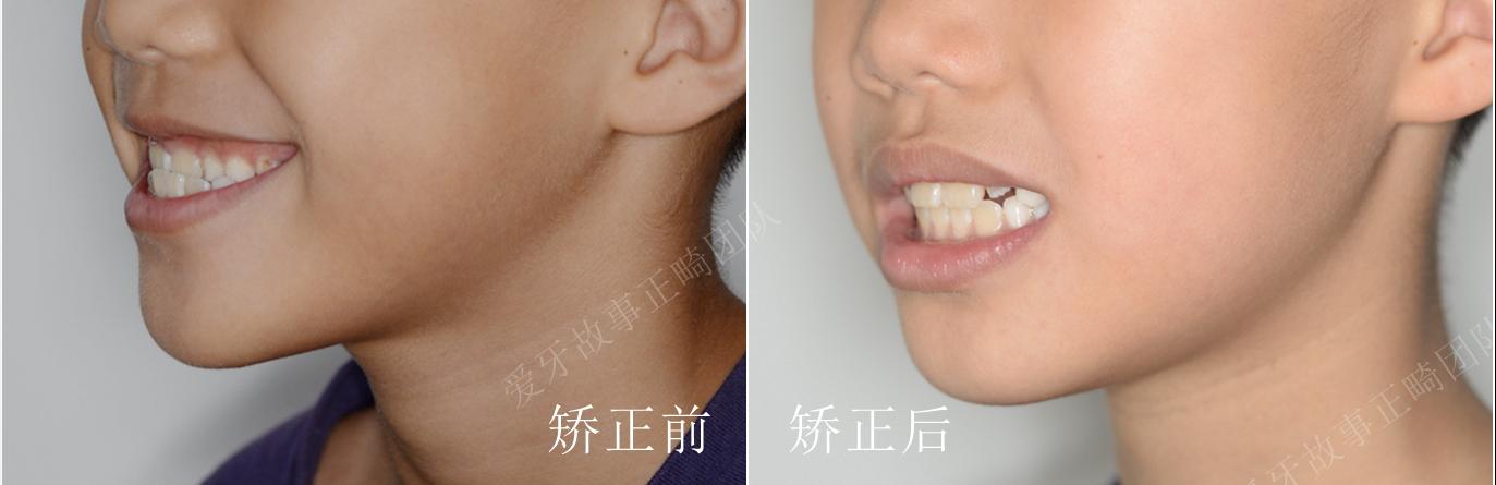 孩子换牙期反颌用治疗吗,如何矫正前牙反颌