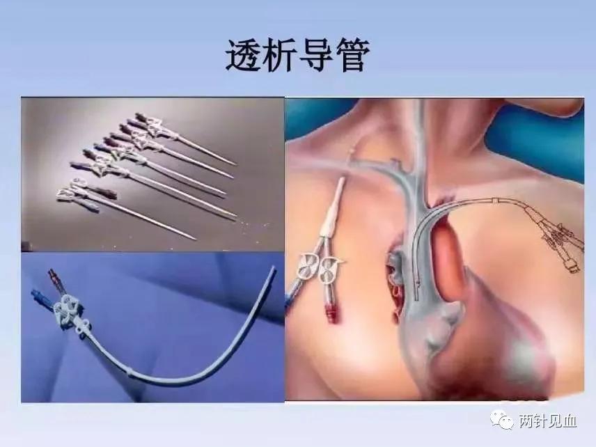 长期透析导管渗血处理,透析针口渗血怎么办