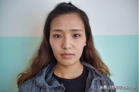 30岁脸部松垮下垂要做拉皮吗,35岁面部松弛怎么办