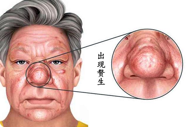疮疤性痤疮,丘疹型玫瑰疮怎么治