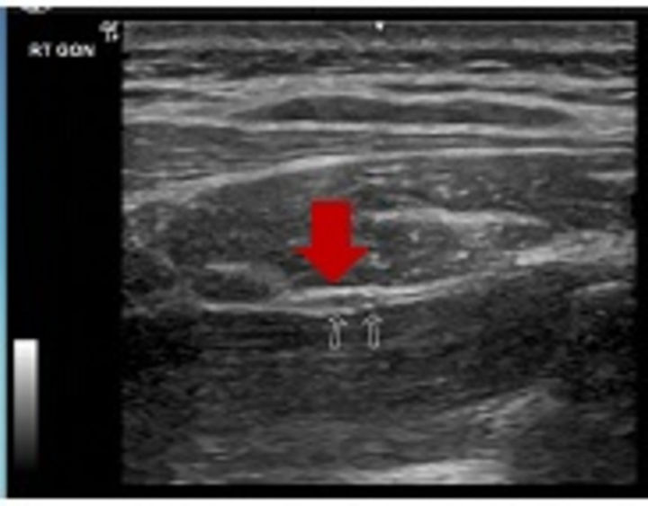 头痛导致耳神经也痛,枕神经疼会引起头顶痛眼睛胀痛吗