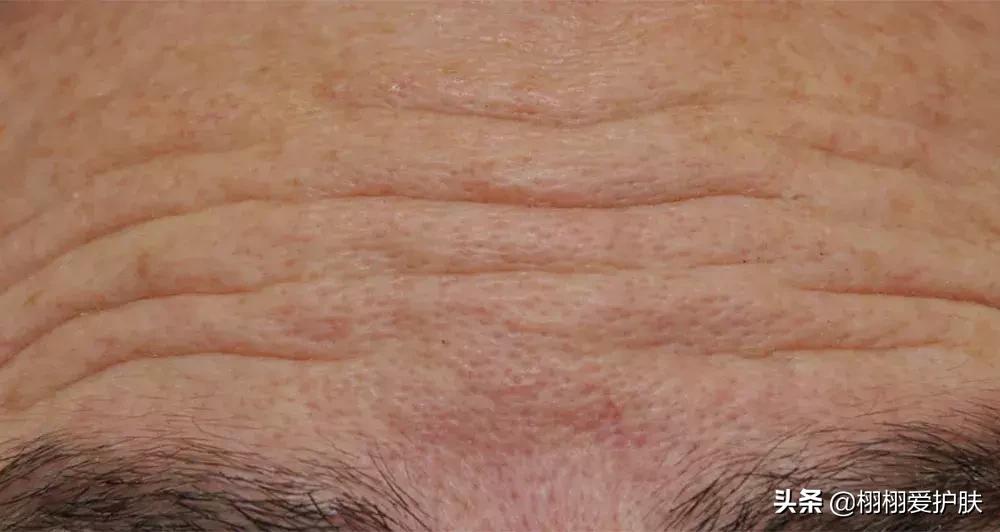 额头抬头纹怎么去除男生,抬头纹怎么去除男生手术