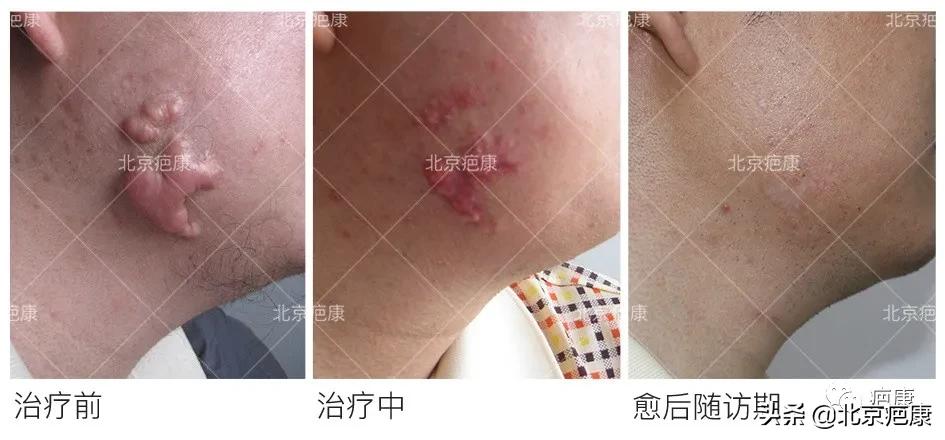 疤痕修复美容仪器多少钱,疤痕增生最好的仪器