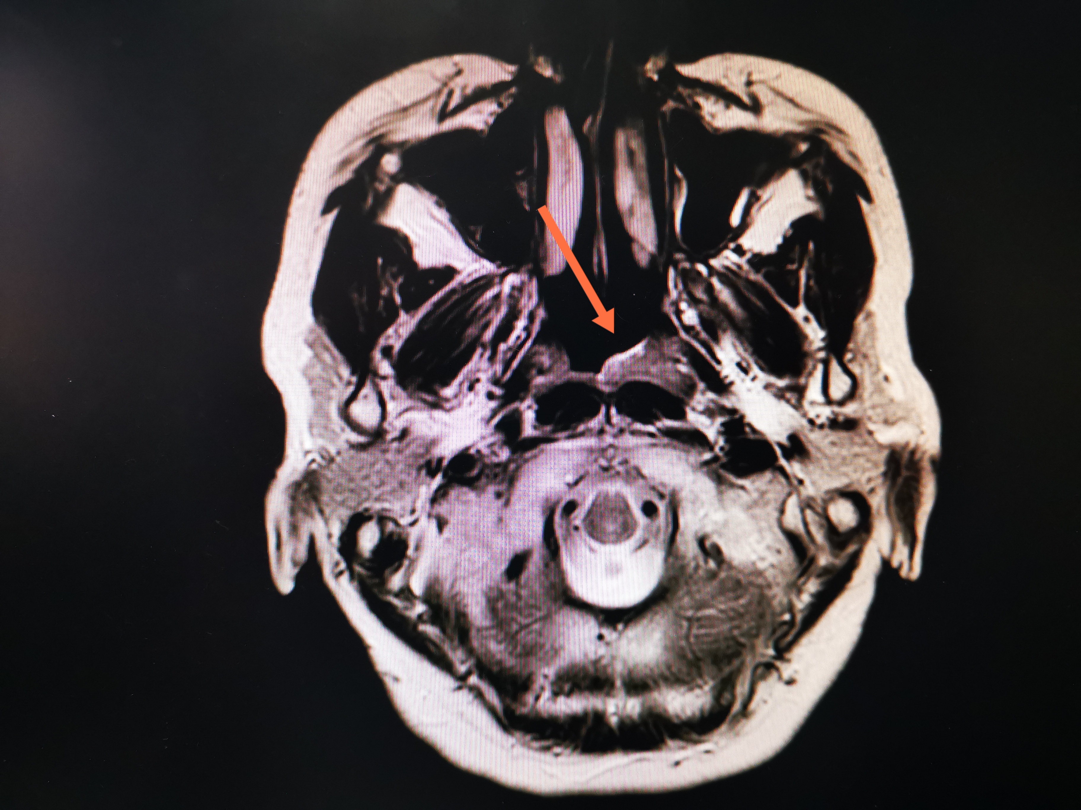 鼻咽癌临床诊断和治疗指南,实例讲述鼻咽癌诊治过程