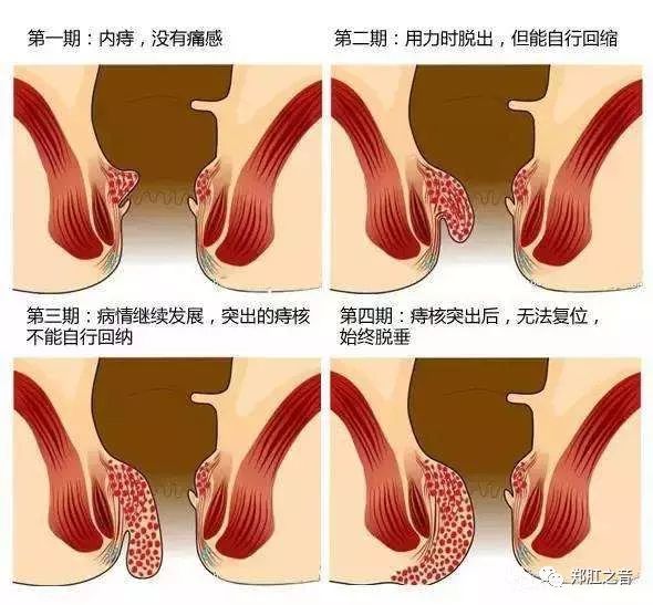 内外混合痔疮自己怎么分辨,怎么区分外痔疮类型