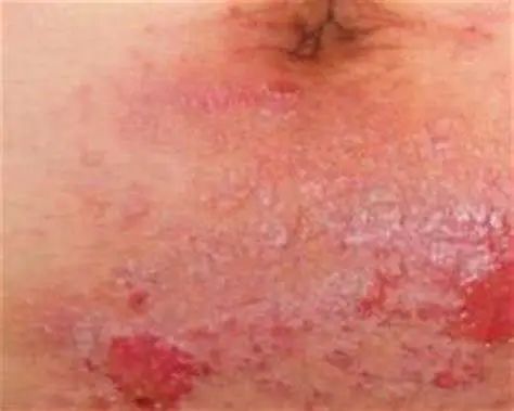 湿疹是癌症的前兆吗,湿疹变银屑病