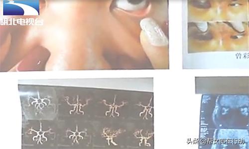 整形失败眼睛失明,女子微整形导致失明