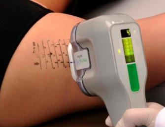 腋臭特效药一览表,miradry微波腋臭手术哪里可以做