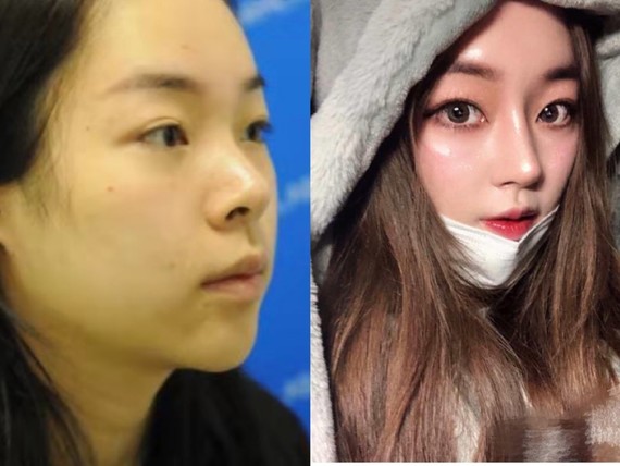 韩国医生整形日记,韩国医生鼻综合