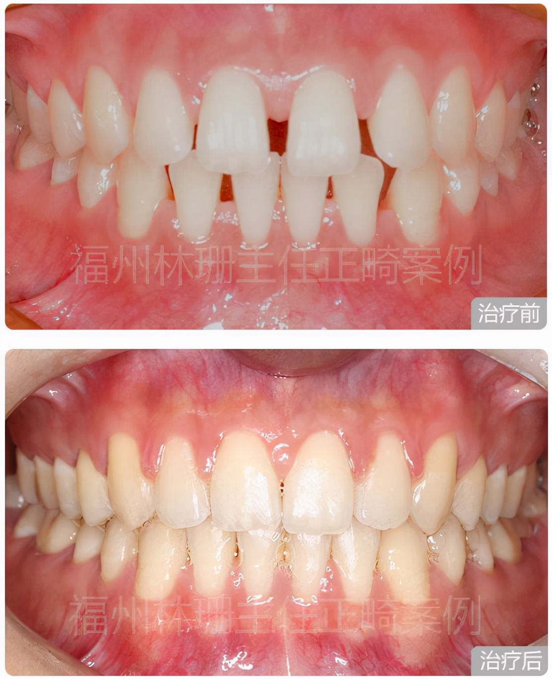 福州牙齿矫正林珊主任,牙齿矫正林珊主任