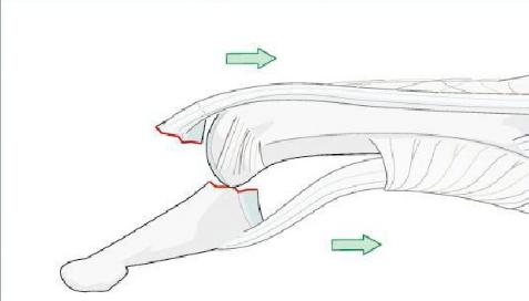 打篮球杵了下手指头,医生告诉要做手术?该不是小题大做吧
