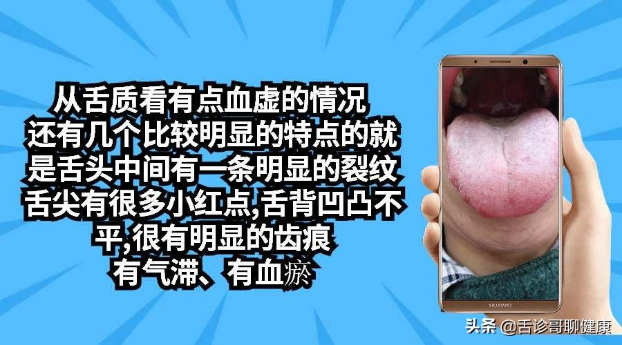 舌诊歌舌象分析与感悟,舌诊哥聊健康痰湿