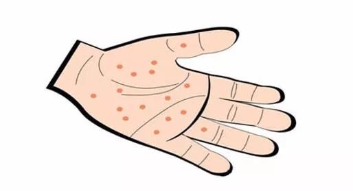 冬天预防皮肤干燥瘙痒,冬季手癣消失夏季手癣严重