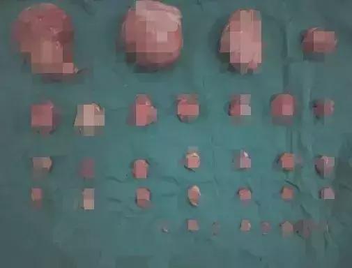 女子肚子竟像怀孕5个月,未婚女子肚子离奇变大