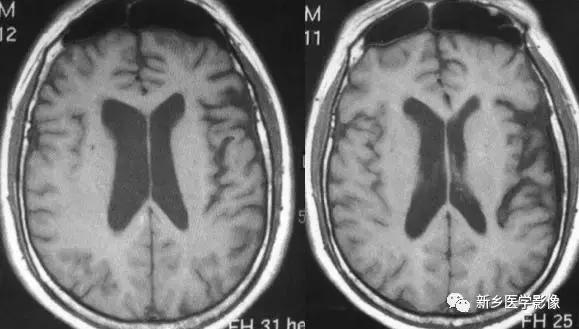 脑室为什么会扩张,脑室为什么会变小